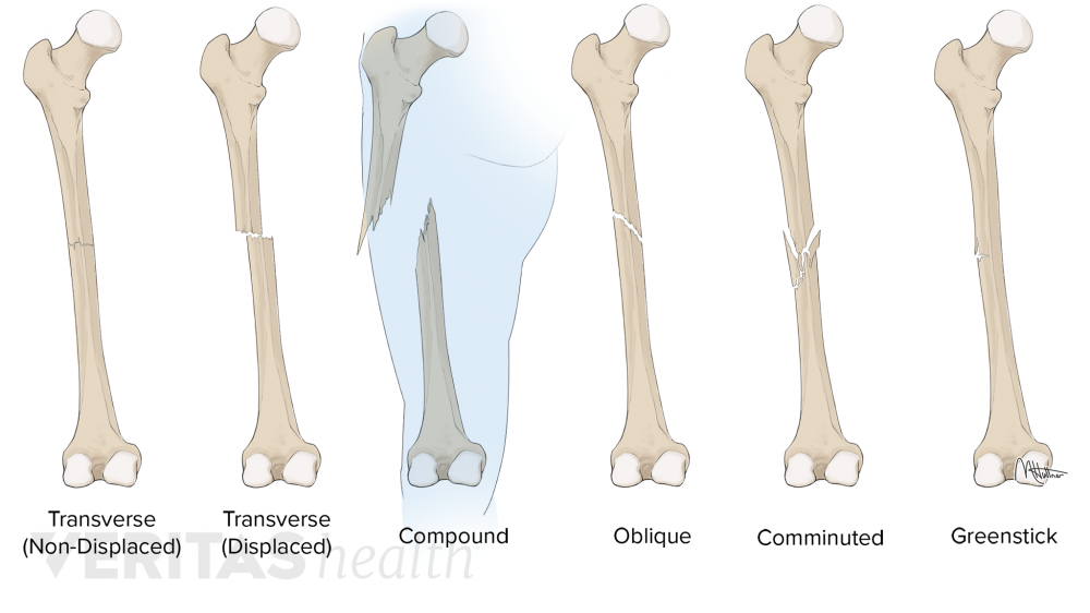 miscelanious-subjects-and-news-the-difference-between-a-bone-break-and